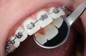 Close-up dental braces on teeth. Orthodontic Treatment