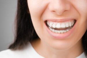 Happy woman with a perfect smile in transparent aligners on her teeth. Removable braces